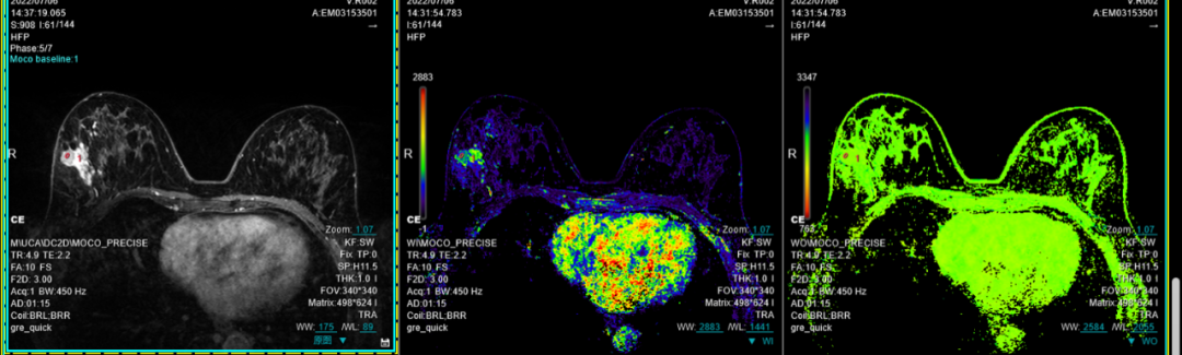 联影磁共振怎么样平原县第一人民医院联影uMR780 光梭3.0T磁共振正式投入使用，开启医学影像新时代！_https://www.jmylbn.com_新闻资讯_第10张