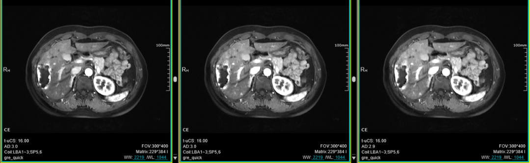 联影磁共振怎么样平原县第一人民医院联影uMR780 光梭3.0T磁共振正式投入使用，开启医学影像新时代！_https://www.jmylbn.com_新闻资讯_第28张