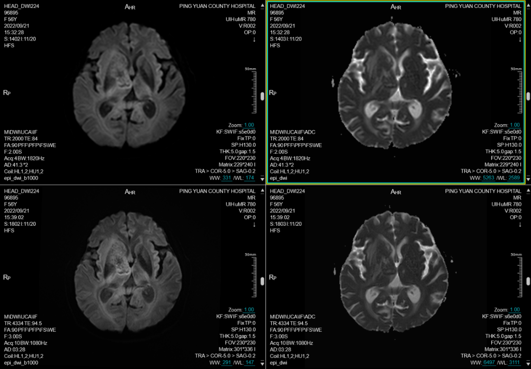 联影磁共振怎么样平原县第一人民医院联影uMR780 光梭3.0T磁共振正式投入使用，开启医学影像新时代！_https://www.jmylbn.com_新闻资讯_第7张