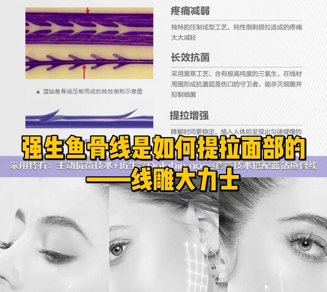 强生线用于什么手术强生鱼骨线丨产品介绍及使用说明（含视频）-上海聚慕医疗器械有限公司