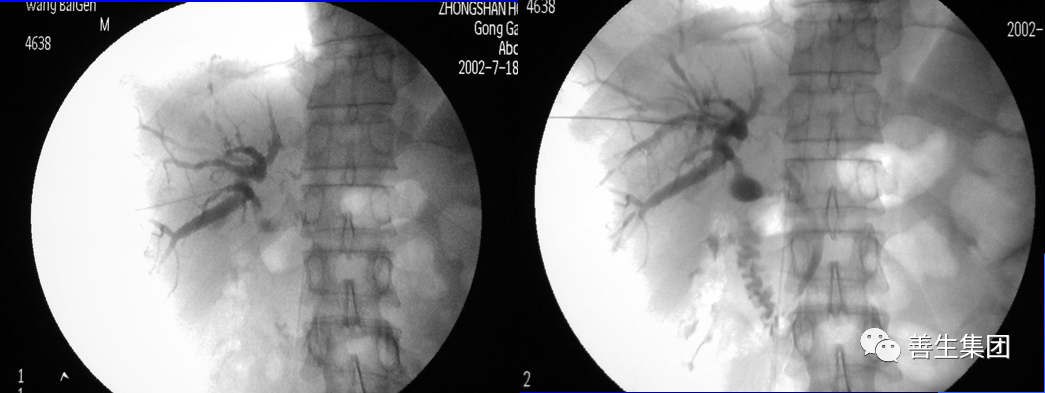 胆管支架什么样子经皮肝胆管穿刺置管引流术（PTCD）及胆道内支架临床应用_https://www.jmylbn.com_新闻资讯_第20张