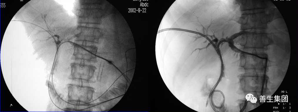 胆管支架什么样子经皮肝胆管穿刺置管引流术（PTCD）及胆道内支架临床应用_https://www.jmylbn.com_新闻资讯_第17张