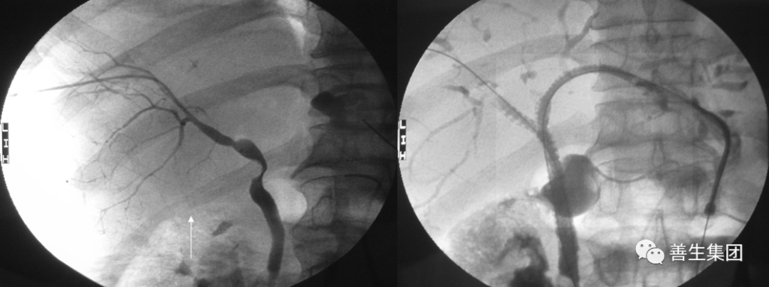 胆管支架什么样子经皮肝胆管穿刺置管引流术（PTCD）及胆道内支架临床应用_https://www.jmylbn.com_新闻资讯_第11张