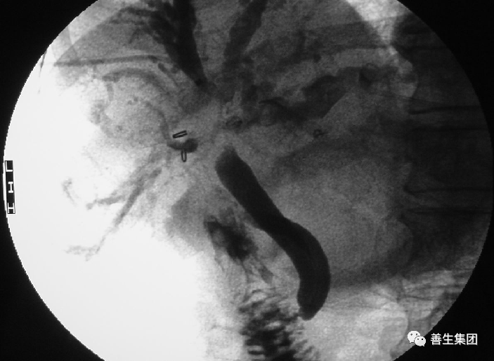 胆管支架什么样子经皮肝胆管穿刺置管引流术（PTCD）及胆道内支架临床应用_https://www.jmylbn.com_新闻资讯_第9张