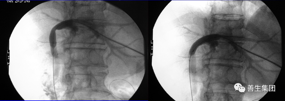 胆管支架什么样子经皮肝胆管穿刺置管引流术（PTCD）及胆道内支架临床应用_https://www.jmylbn.com_新闻资讯_第25张