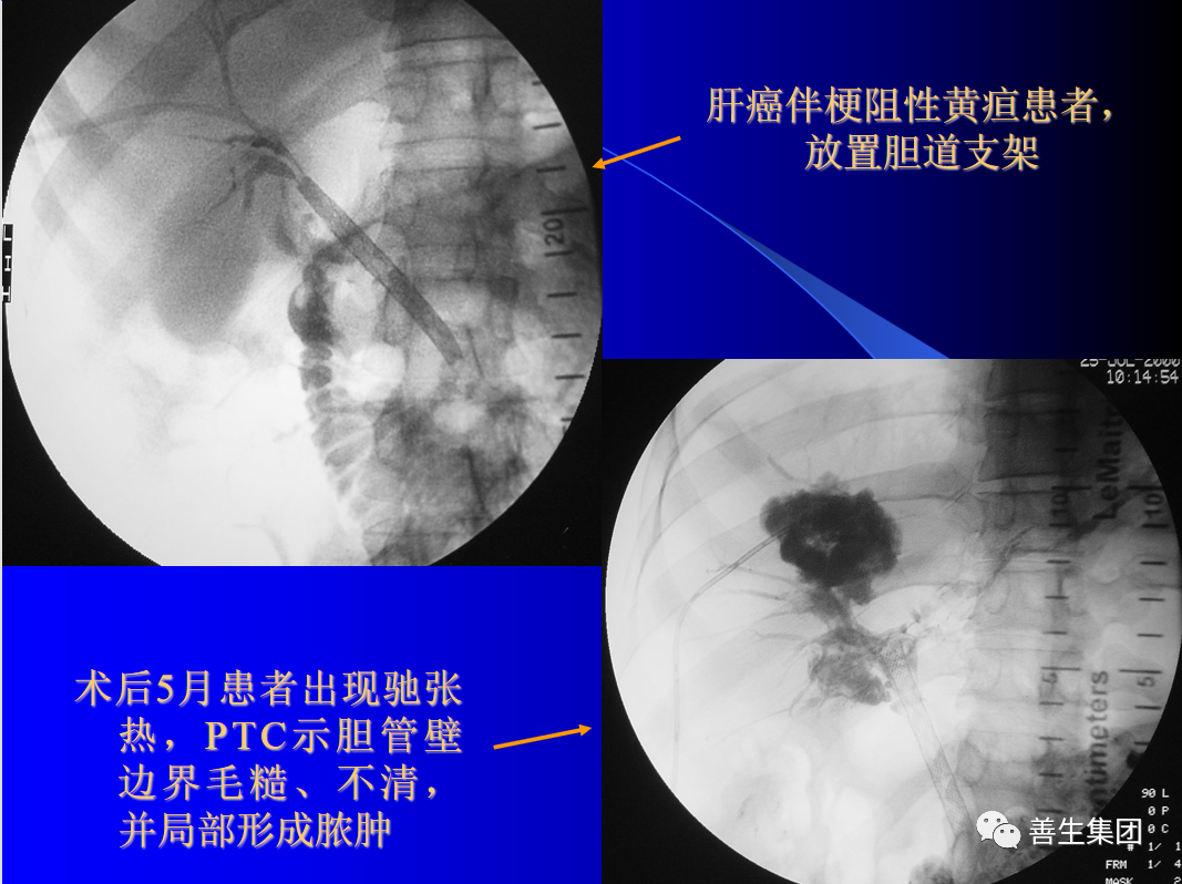 胆管支架什么样子经皮肝胆管穿刺置管引流术（PTCD）及胆道内支架临床应用_https://www.jmylbn.com_新闻资讯_第6张