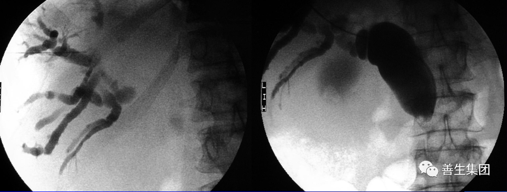 胆管支架什么样子经皮肝胆管穿刺置管引流术（PTCD）及胆道内支架临床应用_https://www.jmylbn.com_新闻资讯_第14张