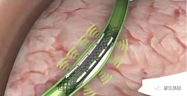 胆管支架什么样子经皮肝胆管穿刺置管引流术（PTCD）及胆道内支架临床应用_https://www.jmylbn.com_新闻资讯_第4张