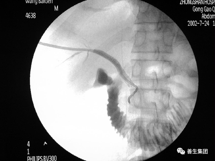 胆管支架什么样子经皮肝胆管穿刺置管引流术（PTCD）及胆道内支架临床应用_https://www.jmylbn.com_新闻资讯_第22张