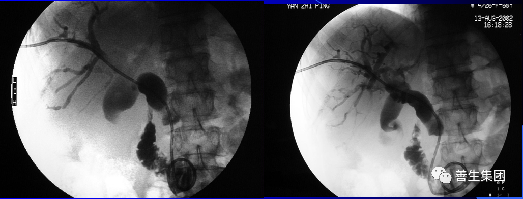 胆管支架什么样子经皮肝胆管穿刺置管引流术（PTCD）及胆道内支架临床应用_https://www.jmylbn.com_新闻资讯_第19张