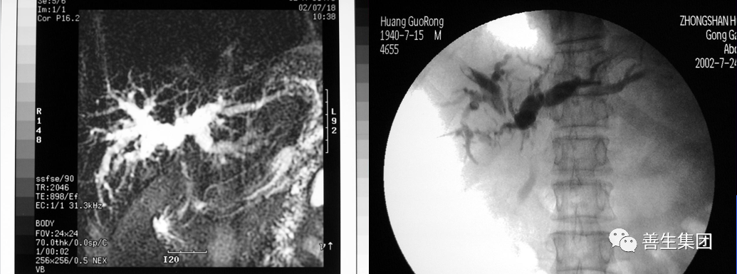 胆管支架什么样子经皮肝胆管穿刺置管引流术（PTCD）及胆道内支架临床应用_https://www.jmylbn.com_新闻资讯_第16张