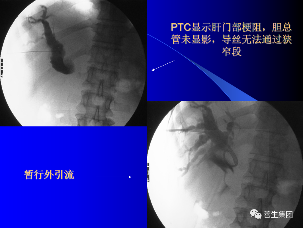胆管支架什么样子经皮肝胆管穿刺置管引流术（PTCD）及胆道内支架临床应用_https://www.jmylbn.com_新闻资讯_第7张