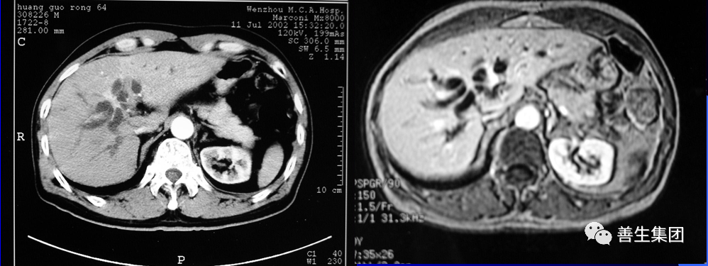 胆管支架什么样子经皮肝胆管穿刺置管引流术（PTCD）及胆道内支架临床应用_https://www.jmylbn.com_新闻资讯_第15张