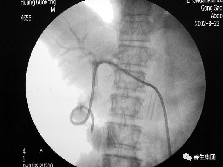 胆管支架什么样子经皮肝胆管穿刺置管引流术（PTCD）及胆道内支架临床应用_https://www.jmylbn.com_新闻资讯_第18张