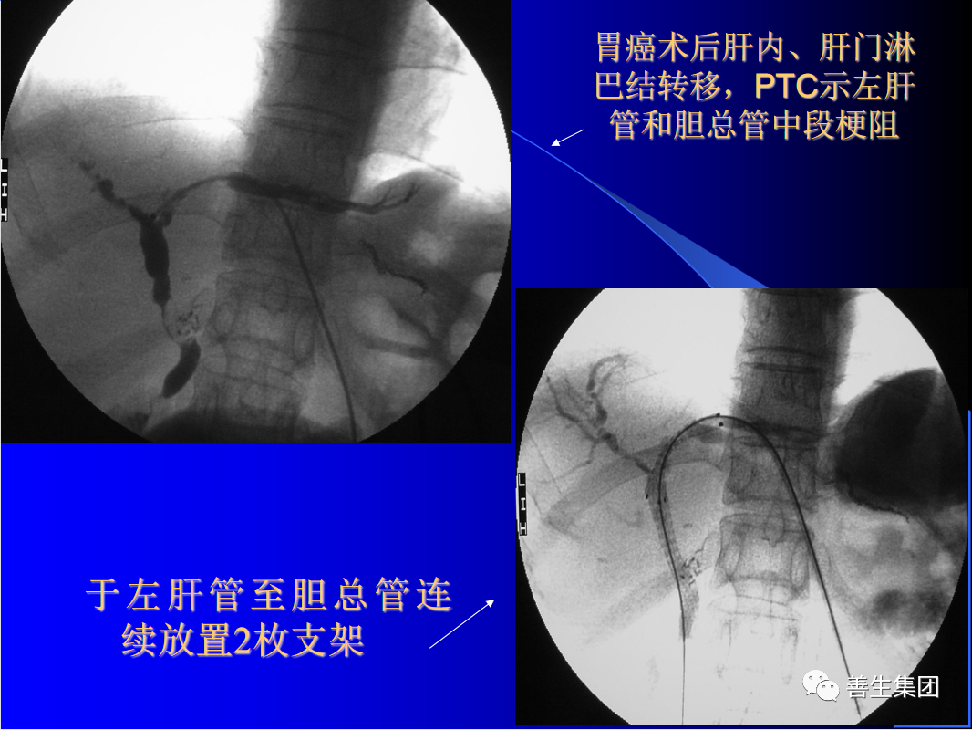 胆管支架什么样子经皮肝胆管穿刺置管引流术（PTCD）及胆道内支架临床应用_https://www.jmylbn.com_新闻资讯_第12张