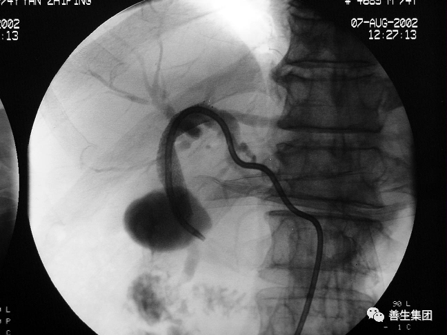 胆管支架什么样子经皮肝胆管穿刺置管引流术（PTCD）及胆道内支架临床应用_https://www.jmylbn.com_新闻资讯_第26张