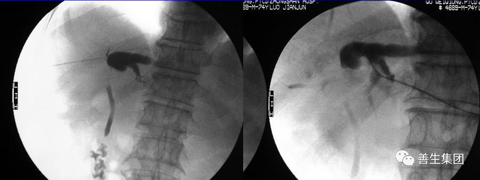 胆管支架什么样子经皮肝胆管穿刺置管引流术（PTCD）及胆道内支架临床应用_https://www.jmylbn.com_新闻资讯_第23张
