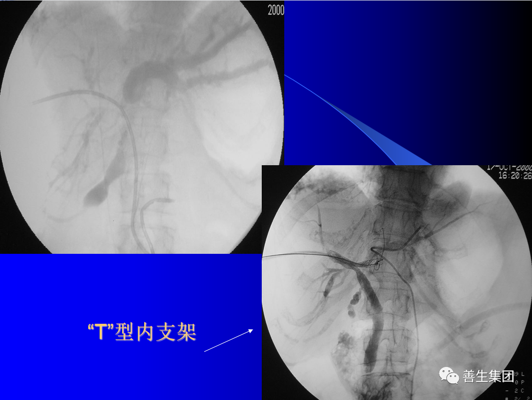 胆管支架什么样子经皮肝胆管穿刺置管引流术（PTCD）及胆道内支架临床应用_https://www.jmylbn.com_新闻资讯_第13张