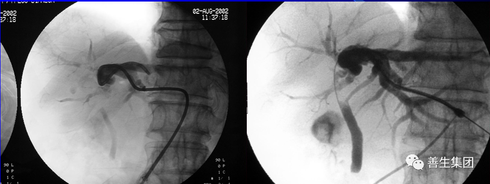 胆管支架什么样子经皮肝胆管穿刺置管引流术（PTCD）及胆道内支架临床应用_https://www.jmylbn.com_新闻资讯_第24张