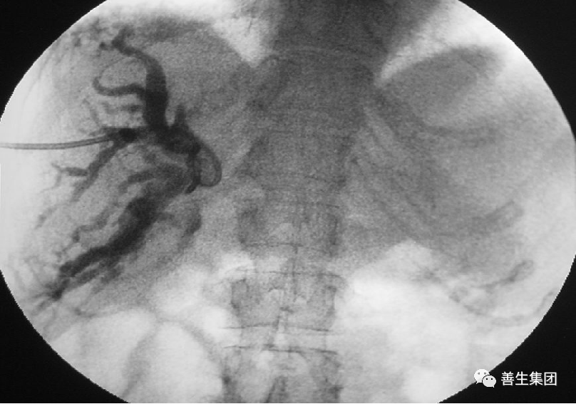 胆管支架什么样子经皮肝胆管穿刺置管引流术（PTCD）及胆道内支架临床应用_https://www.jmylbn.com_新闻资讯_第10张
