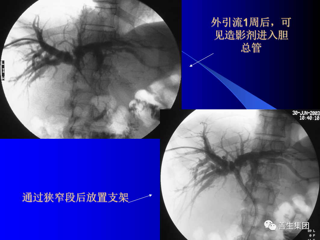 胆管支架什么样子经皮肝胆管穿刺置管引流术（PTCD）及胆道内支架临床应用_https://www.jmylbn.com_新闻资讯_第8张