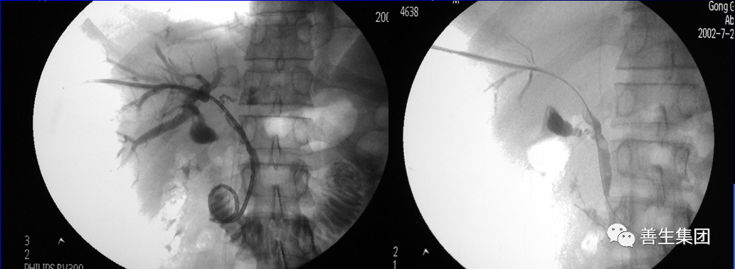 胆管支架什么样子经皮肝胆管穿刺置管引流术（PTCD）及胆道内支架临床应用_https://www.jmylbn.com_新闻资讯_第21张