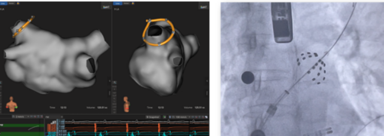 房颤脉冲消融围手术期管理：一例术后溶血病例的临床启示