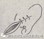 手术工具怎么消毒外科基本手术_https://www.jmylbn.com_新闻资讯_第26张