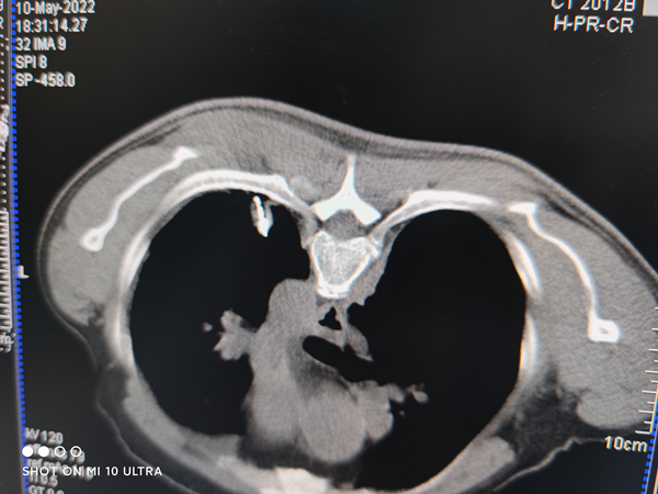 微波针是什么广药三院丨微波消融，一根针、10分钟肿瘤定点清除_https://www.jmylbn.com_新闻资讯_第5张