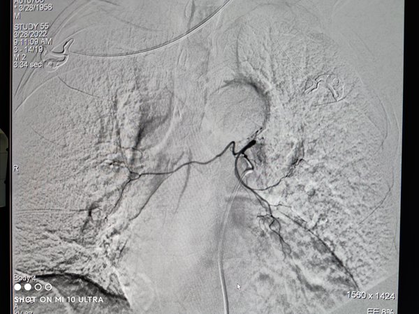 微波针是什么广药三院丨微波消融，一根针、10分钟肿瘤定点清除_https://www.jmylbn.com_新闻资讯_第4张