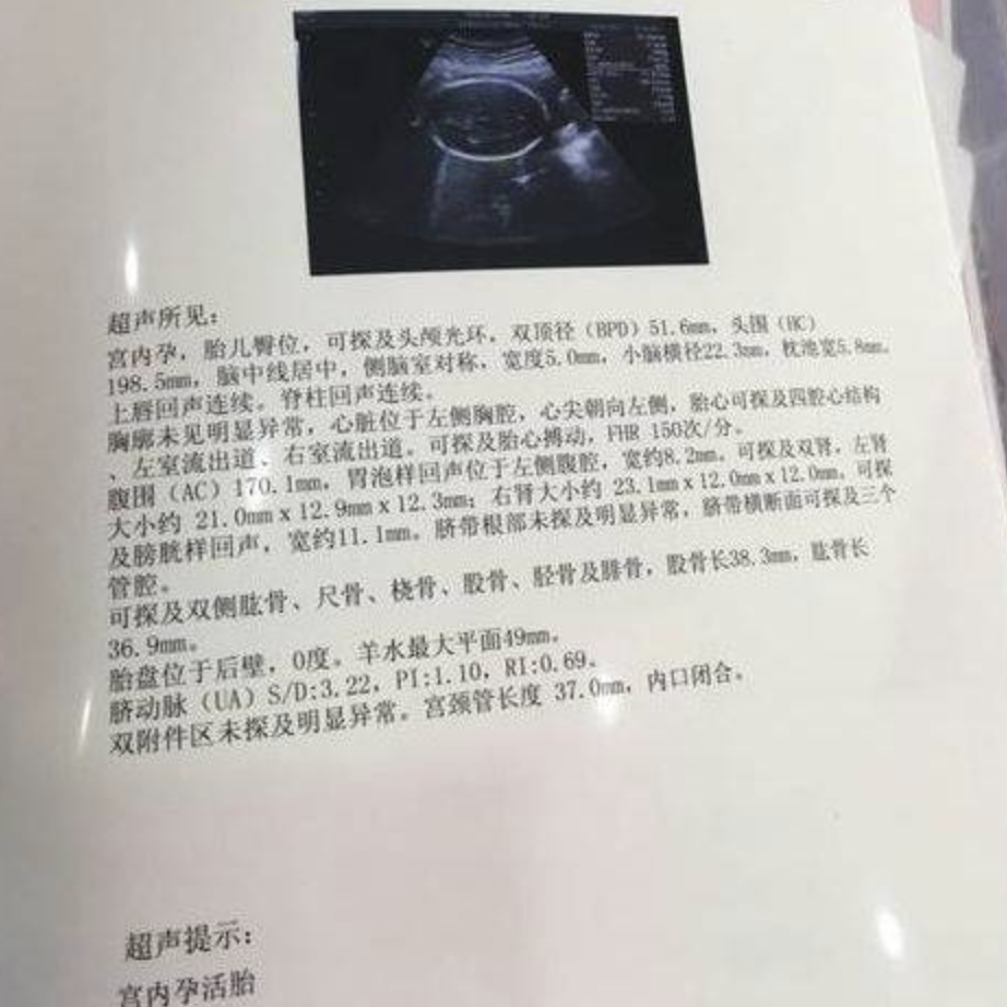 眼科ab超单怎么看干货！博妈教你如何看懂B超单_https://www.jmylbn.com_新闻资讯_第3张