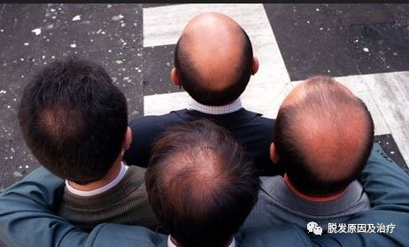 脱发等级对比图，来看看你属于几级？