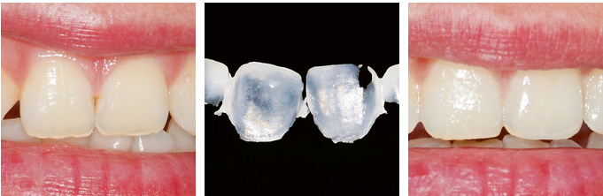 牙科DMG怎么用的Vitique为媒，德国DMG携手爱尔创联袂拓展中国口腔美学市场 ｜ 行业观察_https://www.jmylbn.com_新闻资讯_第6张