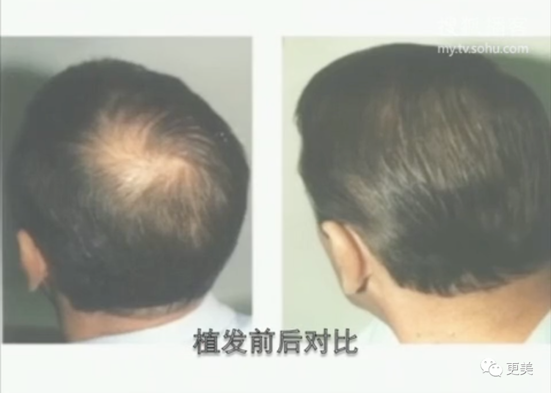 【整容】四千年美女鞠婧祎疑似连头皮都整了？！网友吐槽：是个狠人（组图） - 32