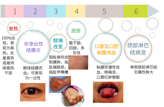 兒童的一種發熱叫川崎病