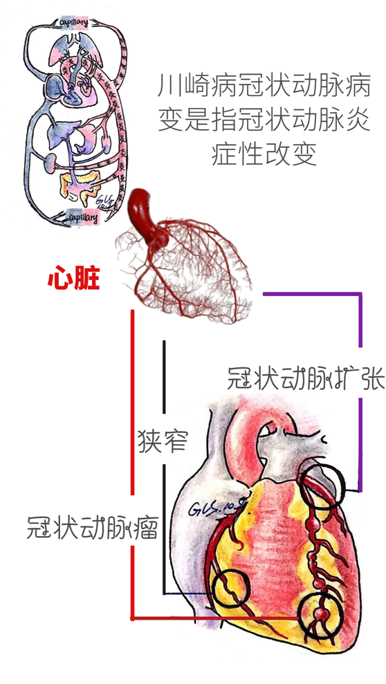 冠状动脉窦瘤图片