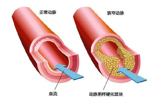 血脂正常，为什么还要吃他汀类药物？哪些人群需要服用他汀？