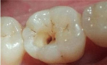 牙缝里的牙垢又臭又硬，教你1个小妙招，脏牙垢自动掉落！