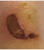 康复治疗激光怎么收费【康复治疗】物理因子之光—氦氖激光_https://www.jmylbn.com_新闻资讯_第7张