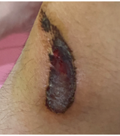 康复治疗激光怎么收费【康复治疗】物理因子之光—氦氖激光_https://www.jmylbn.com_新闻资讯_第8张