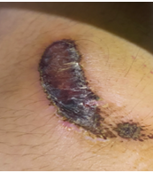 康复治疗激光怎么收费【康复治疗】物理因子之光—氦氖激光_https://www.jmylbn.com_新闻资讯_第9张