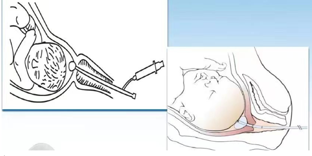 子宫颈扩张球囊是什么宫颈扩张球囊，顺产妈妈的福音_https://www.jmylbn.com_新闻资讯_第6张