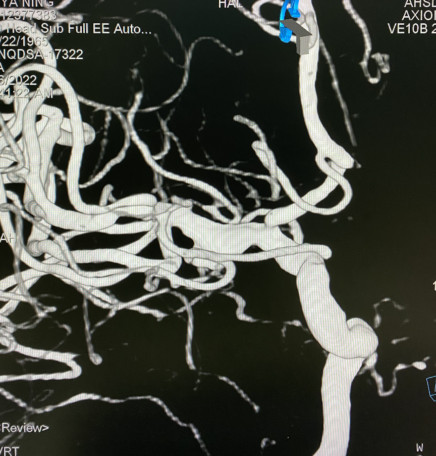 什么达医畅疗·第一期 ｜ 畅医达（Choydar）17小系统血流导向装置治疗大脑中动脉动脉瘤两例_https://www.jmylbn.com_新闻资讯_第23张