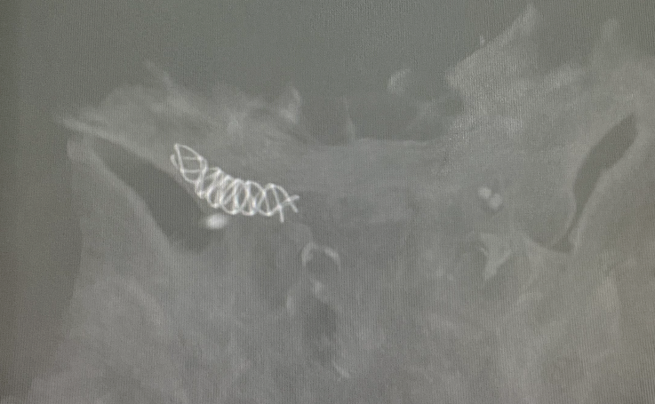 什么达医畅疗·第一期 ｜ 畅医达（Choydar）17小系统血流导向装置治疗大脑中动脉动脉瘤两例_https://www.jmylbn.com_新闻资讯_第25张