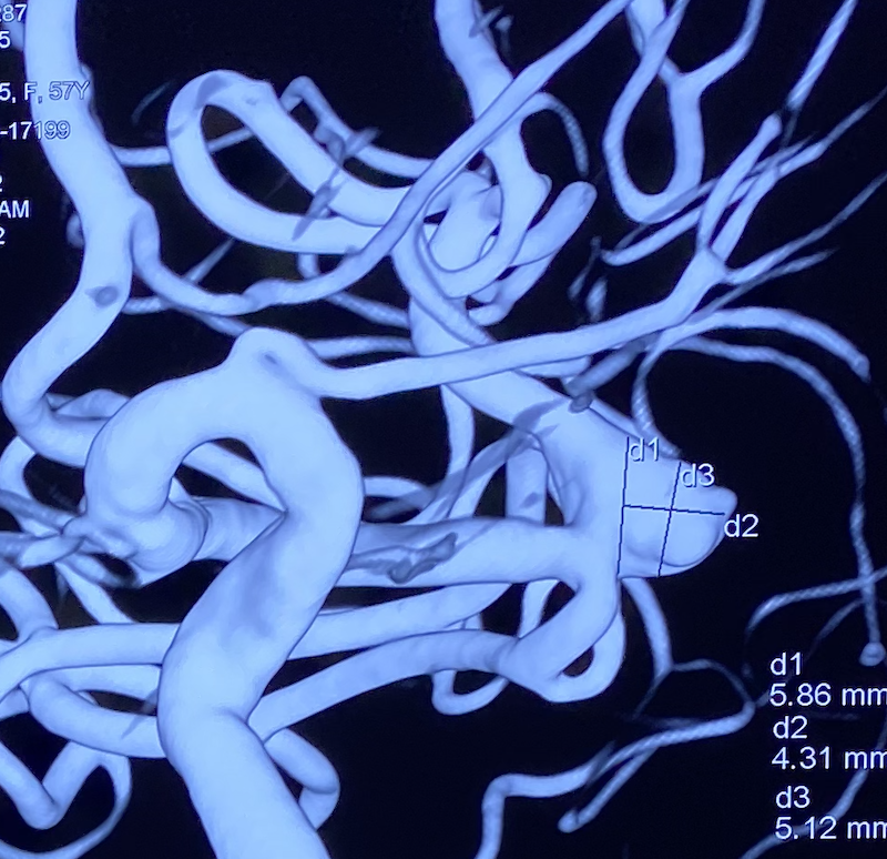 什么达医畅疗·第一期 ｜ 畅医达（Choydar）17小系统血流导向装置治疗大脑中动脉动脉瘤两例_https://www.jmylbn.com_新闻资讯_第6张