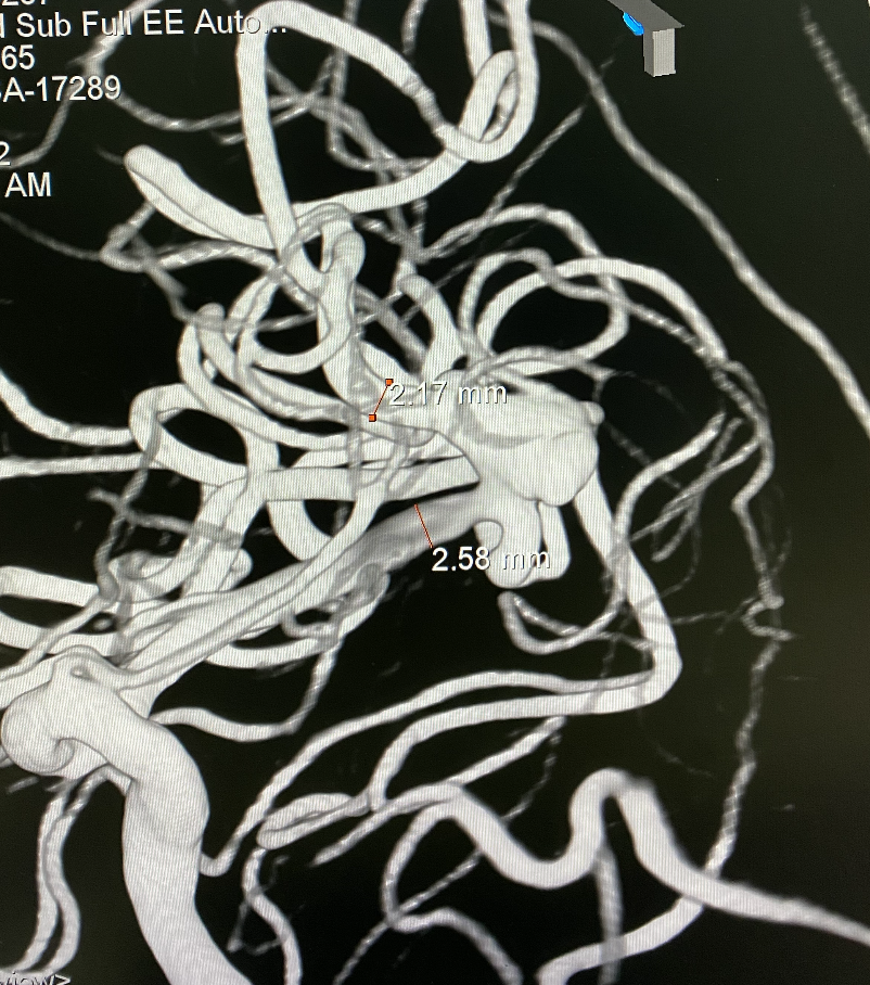 什么达医畅疗·第一期 ｜ 畅医达（Choydar）17小系统血流导向装置治疗大脑中动脉动脉瘤两例_https://www.jmylbn.com_新闻资讯_第9张