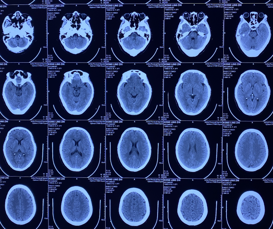 什么达医畅疗·第一期 ｜ 畅医达（Choydar）17小系统血流导向装置治疗大脑中动脉动脉瘤两例_https://www.jmylbn.com_新闻资讯_第4张