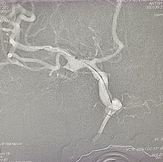 什么达医畅疗·第一期 ｜ 畅医达（Choydar）17小系统血流导向装置治疗大脑中动脉动脉瘤两例_https://www.jmylbn.com_新闻资讯_第24张