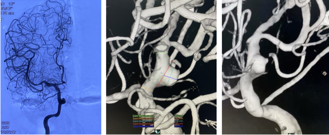 什么达医畅疗·第一期 ｜ 畅医达（Choydar）17小系统血流导向装置治疗大脑中动脉动脉瘤两例_https://www.jmylbn.com_新闻资讯_第22张