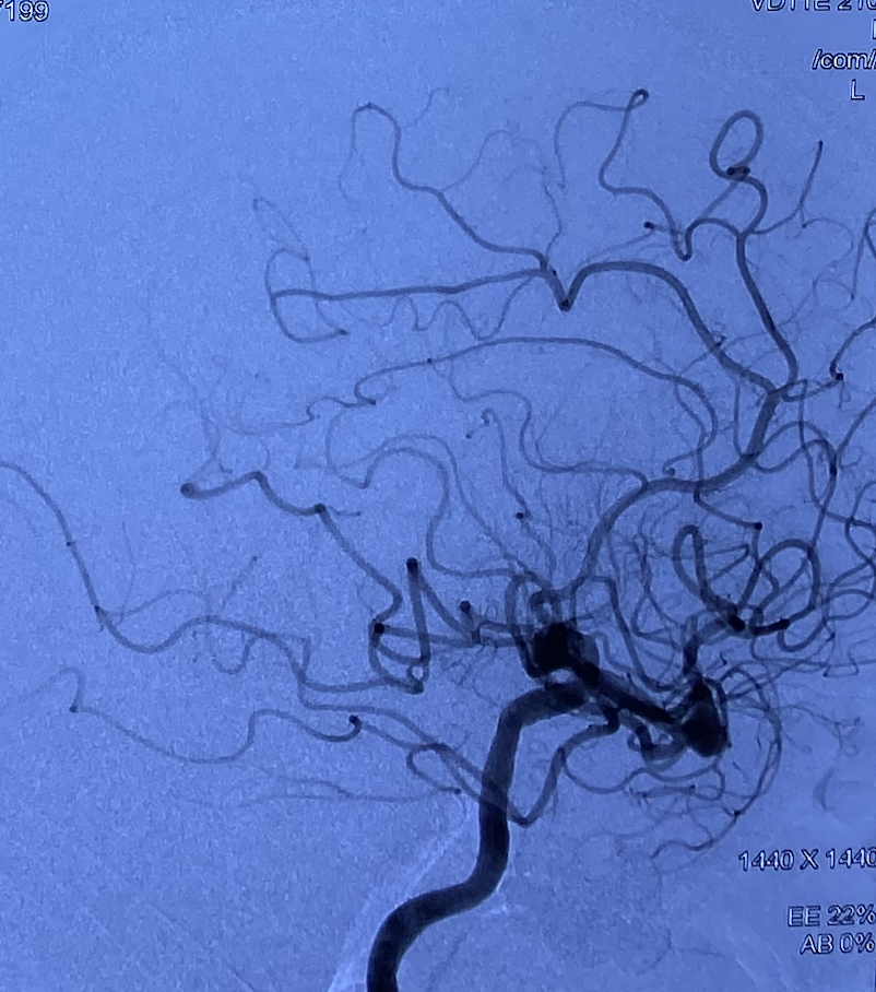 什么达医畅疗·第一期 ｜ 畅医达（Choydar）17小系统血流导向装置治疗大脑中动脉动脉瘤两例_https://www.jmylbn.com_新闻资讯_第8张